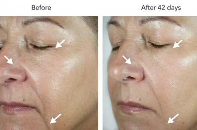 RejuveNAD Before After